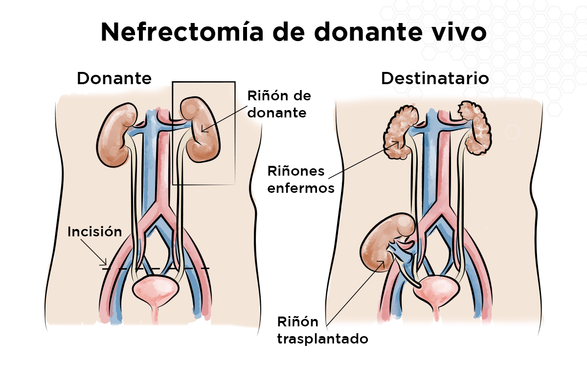 Nefrectom�a de donante vivo